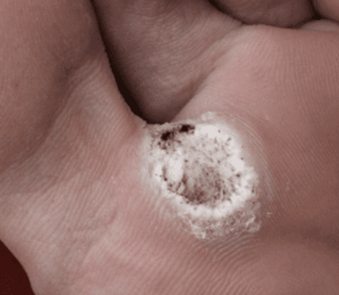 What are Warts and Verrucae?